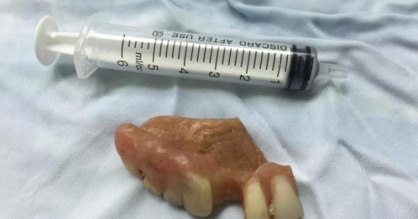 Nghệ An: Ăn bún, người đàn ông nuốt luôn hàm răng giả