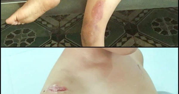 Bắt tạm giam cha dượng bạo hành, châm thuốc lá đang cháy vào người bé trai 6 tuổi