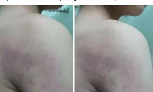 Giáo viên trường Tiểu học Kiêu Kỵ bị tố đánh học sinh tím khắp người?