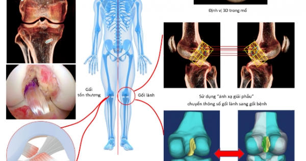 Vinmec tái tạo chính xác dây chằng chéo trước khớp gối với phương pháp “ánh xạ giải phẫu” độc quyền Vinmec tái tạo chính xác dây chằng chéo trước khớp gối với phương pháp “ánh xạ giải phẫu” độc quyền