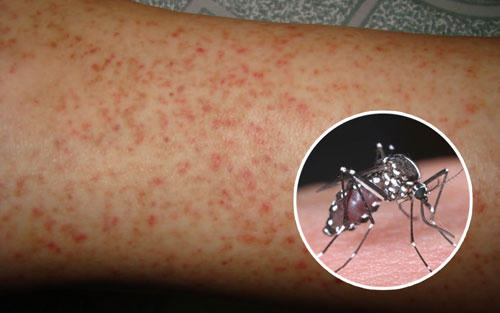 Cảnh giác biến chứng nặng do sốt xuất huyết