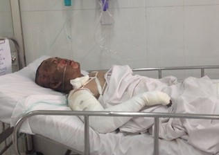 Mâu thuẫn, chồng nhẫn tâm hắt cả ấm nước sôi vào mặt khiến vợ bỏng nặng