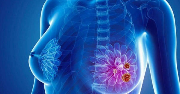 Cảnh báo độ tuổi mắc ung thư vú ngày càng trẻ hóa