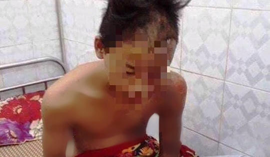 Nam sinh thoát chết kỳ diệu sau khi bị sét đánh cháy xém đầu