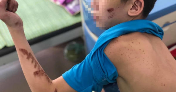 Chuyện đau lòng từ vết sẹo chi chít trên người cậu bé làm thuê
