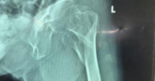 Nối các mảnh xương gãy cho cụ bà 101 tuổi