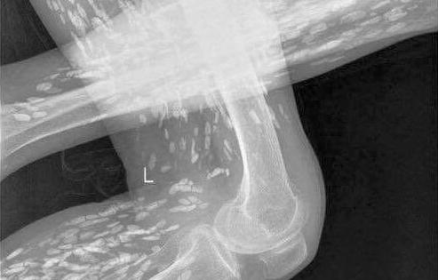 Sán “dạo chơi” trong cơ thể vì ăn tiết canh