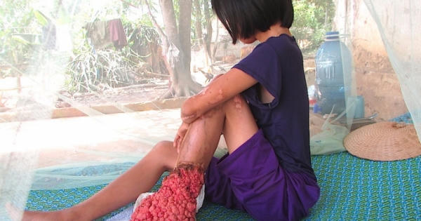 Giật mình với căn bệnh quái lạ của cô gái mới 25 tuổi