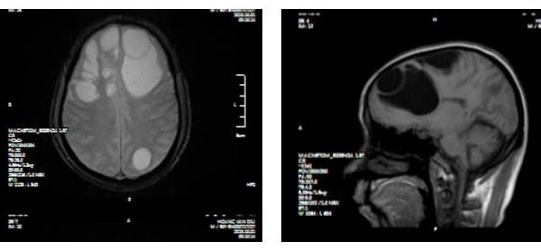 Ổ sán khổng lồ 'lúc nhúc' trong não người đàn ông ở Phú Thọ