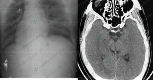 Tài xế hôn mê sâu khi lái xe chỉ vì quên ăn sáng