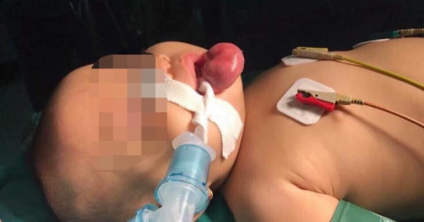 Hành trình giải cứu miệng cho em bé 12 tháng tuổi