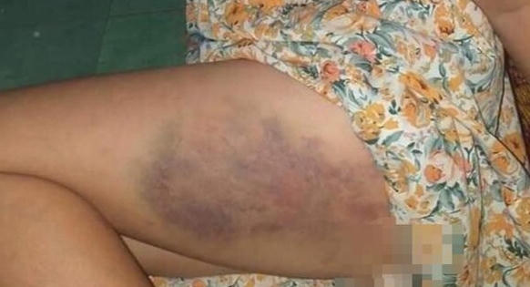 Đắk Lắk: Phạt tiền, tạm đình chỉ giảng dạy 3 tháng với giáo viên đánh bầm đùi học sinh