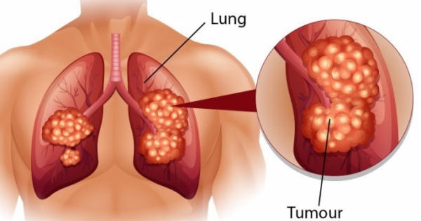 Dấu hiệu điển hình của bệnh ung thư phổi