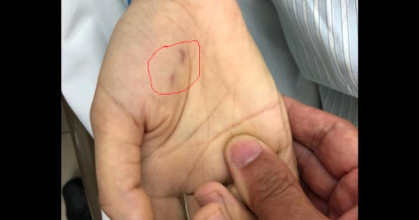 Bị chó ốm cắn vào tay, nữ bác sĩ thú y trẻ tuổi tử vong vì bệnh dại