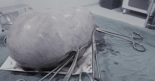 Nghệ An: Cắt bỏ khối u 1,8 kg cho nữ bệnh nhân 40 tuổi Nghệ An: Cắt bỏ khối u 1,8 kg cho nữ bệnh nhân 40 tuổi