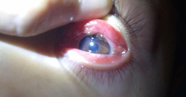 Phát hiện vắt dài 2cm hút no máu trong mắt cháu bé 8 tuổi