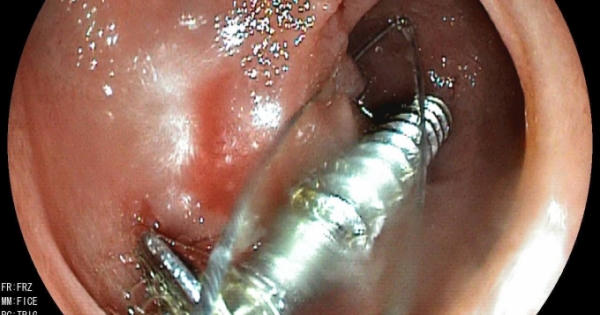 Kinh hoàng hình ảnh ốc vít sắc nhọn dài đến 3,5 cm trong cơ thể bé 20 tháng tuổi