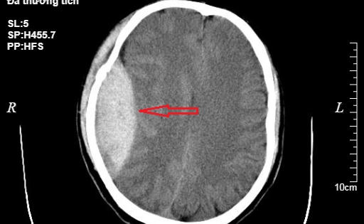 Phẫu thuật cứu sống bệnh nhân ngã từ độ cao 3m