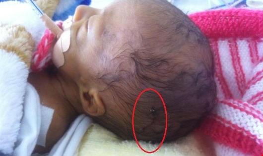 Mổ đẻ làm rách đầu trẻ, giám đốc vẫn cho rằng 'việc không lớn'