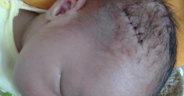 Nghệ An: Gia đình hoảng hốt khi đón bé trai sơ sinh từ phòng mổ với 1 vết rách trên đầu