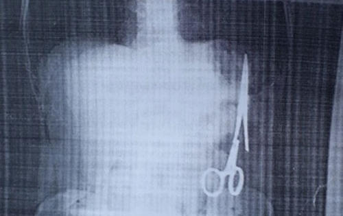 Bộ Y tế vào cuộc vụ "Kéo phẫu thuật bị bỏ quên 18 năm trong bụng bệnh nhân"