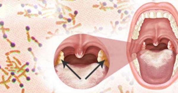 Cục Y tế dự phòng khuyến cáo người dân cần thực hiện 5 bước phòng tránh bệnh Bạch hầu