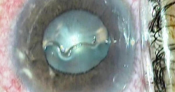 Kinh hãi, giun dài 14mm “bơi lội”, làm tổ trong mắt người phụ nữ