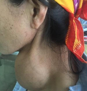 Khối u giáp khổng lồ chèn ép khí quản người phụ nữ 76 tuổi