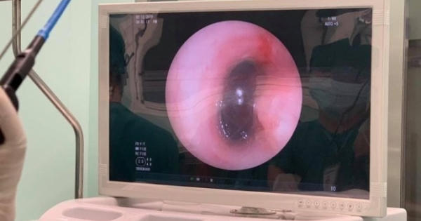 Suýt mất mạng vì hóc hạt sapôchê