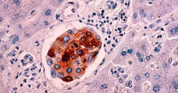 Phương pháp mới phát hiện ung thư trong 10 phút