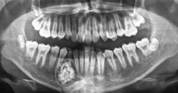 Lấy gần 100 chiếc răng trong khối u răng của bé trai 13 tuổi Lấy gần 100 chiếc răng trong khối u răng của bé trai 13 tuổi