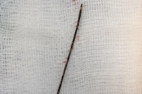 Bé gái 3 tuổi bị kim khâu đâm vào lồng ngực suốt 2 năm