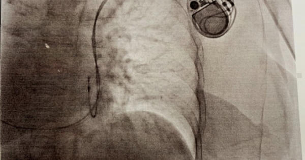 TP.HCM: Cứu nữ bệnh nhân có trái tim bên phải, nhịp tim "siêu chậm".