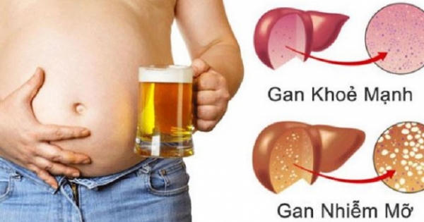 Hiểu nhầm tai hại khiến gan nhiễm mỡ