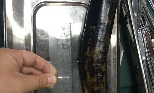 Kinh sợ người đàn ông nhét quả cà tím dài 30cm vào hậu môn để chữa táo bón