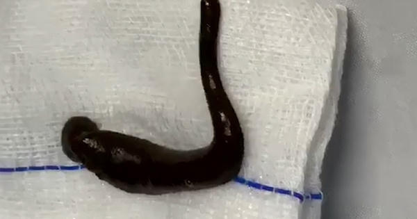 Đỉa trâu dài 15cm ngoe nguẩy trong khí quản người đàn ông