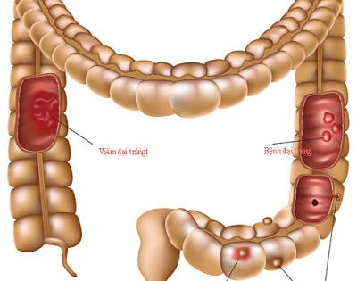 Bí kíp của người Nhật đẩy lùi viêm đại tràng đơn giản mà hiệu quả