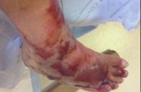 Người đàn ông bị vi khuẩn ăn thịt người “tấn công”