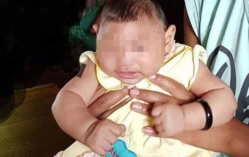 Trẻ nhỏ đầu tiên bị dị tật đầu nhỏ liên quan đến virus Zika tại Việt Nam