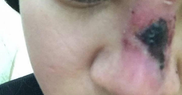 Ám ảnh những hệ quả "kinh hoàng" do phẫu thuật thẩm mỹ hỏng