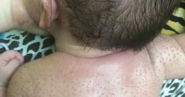 Chữa vặn mình cho trẻ bằng nước chanh và lòng trắng trứng: Cách làm phản khoa học