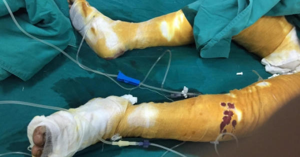 Đốt nhầm can xăng hai vợ chồng bị bỏng nặng