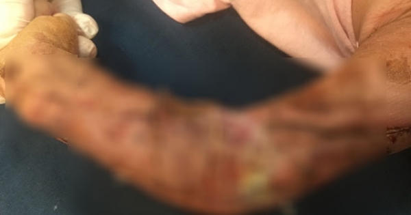 Chập chững ra đường, bé trai 19 tháng tuổi bị xe tải tông dập nát cánh tay Chập chững ra đường, bé trai 19 tháng tuổi bị xe tải tông dập nát cánh tay