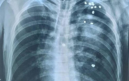 Hy hữu, 20 viên đạn găm vào người vẫn thoát chết Hy hữu, 20 viên đạn găm vào người vẫn thoát chết