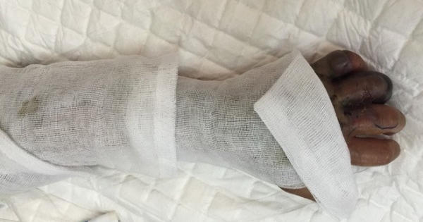 Sự thật về hạt đậu hút được mọi chất độc do côn trùng cắn Sự thật về hạt đậu hút được mọi chất độc do côn trùng cắn