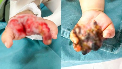 Bé 8 tháng tuổi bị hoại tử bàn tay do tai nạn máy tuốt lúa