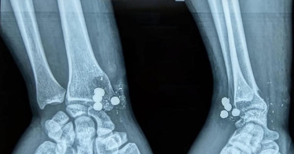 Nghệ An: Bị đạn bắn xuyên tay vì sang nhà bạn nghịch súng