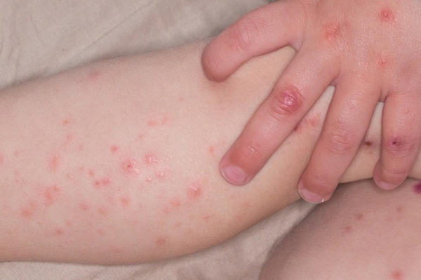 Số ca mắc bệnh chân tay miệng của TP HCM tăng trở lại Số ca mắc bệnh chân tay miệng của TP HCM tăng trở lại