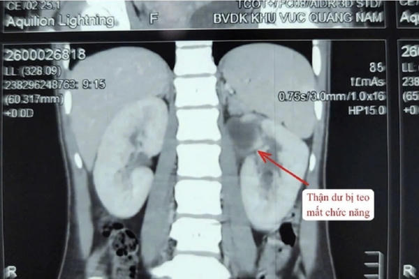 Cảnh báo dị tật hiếm: Cô gái 22 tuổi phát hiện có 3 quả thận khi đã nhiễm trùng nặng Cảnh báo dị tật hiếm: Cô gái 22 tuổi phát hiện có 3 quả thận khi đã nhiễm trùng nặng