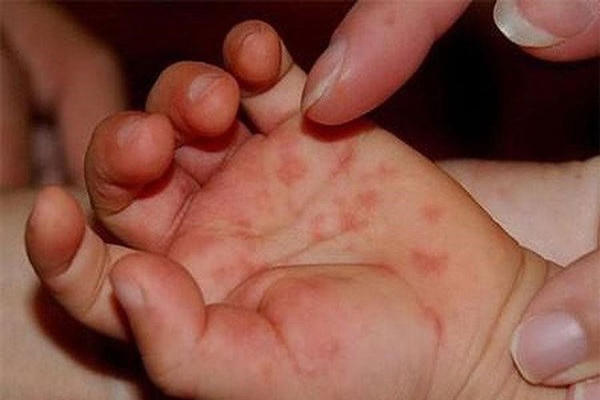 3 tháng đầu năm cả nước ghi nhận hơn 25.000 ca tay chân miệng, Bộ Y tế yêu cầu tăng cường kiểm soát, điều trị 